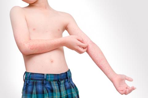Gel de baño para la dermatitis atópica infantil